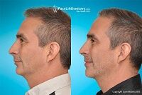 small-jaw-overbite-fix.jpg